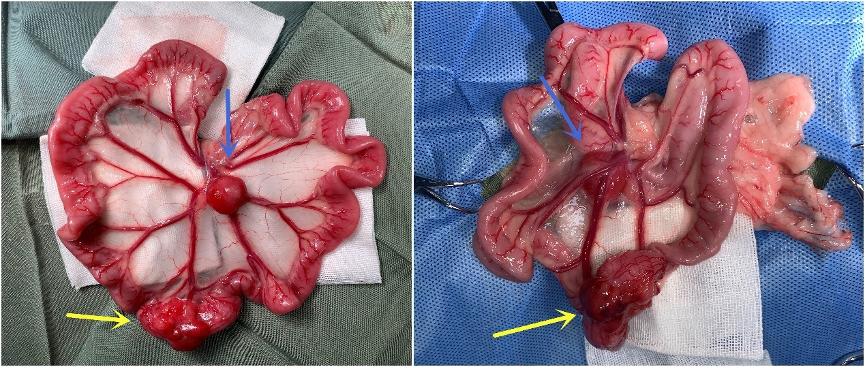 如图1所示,肠系膜根部淋巴结肿大明显,大小约为1.5*2.0*1.