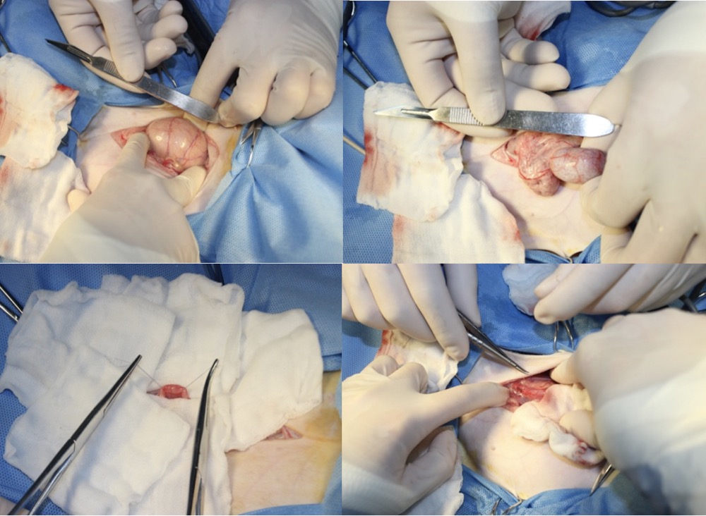 加温无菌生理盐水冲洗腹腔,4/0微乔连续缝合腹壁,结节缝合皮下组织