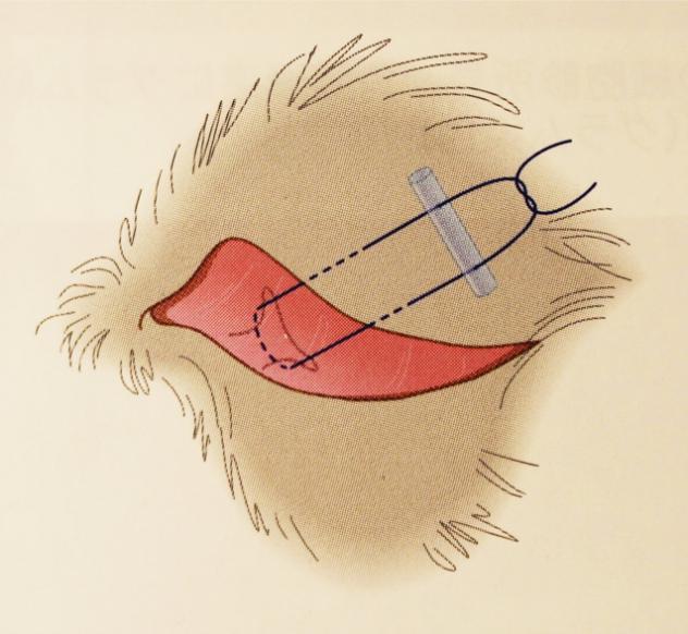 線做水平褥式縫合,自上眼瞼緣外側5mm左右處入針,垂直全層穿透上眼瞼